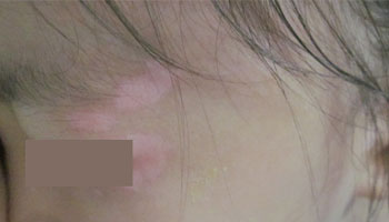 儿童脸上的白斑怎么去除是为什么