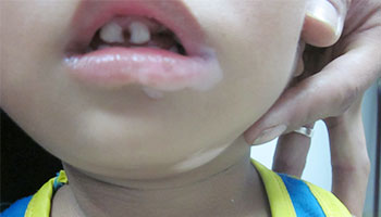 鼻梁上长白癜风一块块的刚开始时症状表现