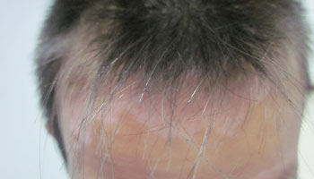 小孩白癜风治疗