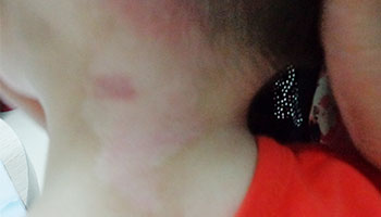 皮肤在伍德灯下显示白色的是白癜风的可能性大吗