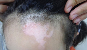 小孩白癜风治疗