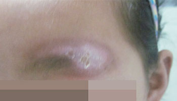 目前治疗儿童白癜风的方法有哪些