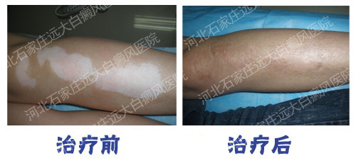 为什么会得完全性白癜风?