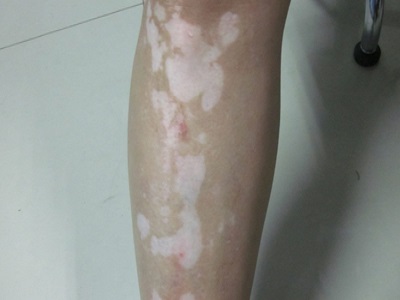 怎么做才能有效防止白癜风的扩散”