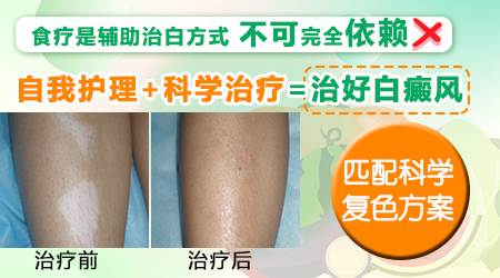 308照白癜风脱皮是不是正常现象”