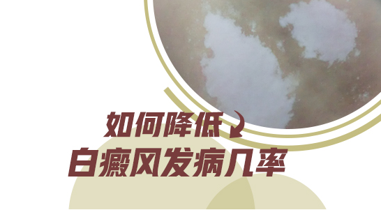 肚子有白癜风该怎么样治疗好”