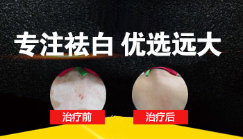 衡水白癜风医院治白癜风怎么样”