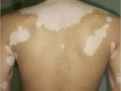 背上有白癜风该怎么治疗”