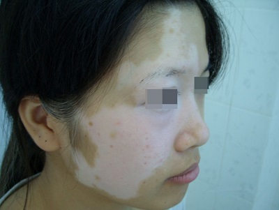 有哪些是女性白癜风症状