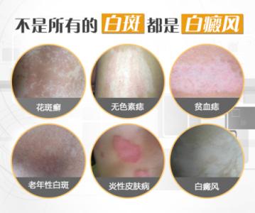 发病初期的白癜风是长什么样的啊”