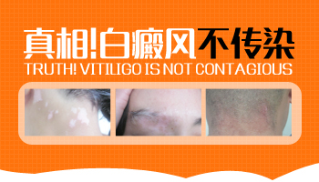 白癜风会通过血液传染吗