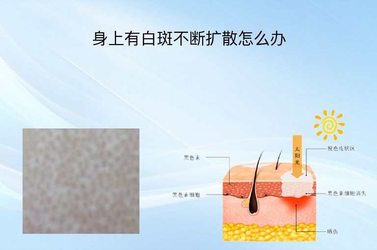 身上有白斑不断扩散怎么办”