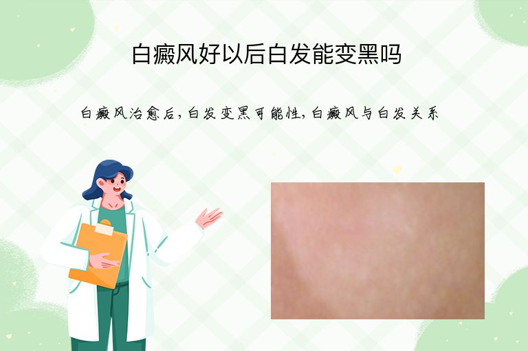 白癜风好以后白发能变黑吗”