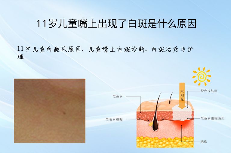 11岁儿童嘴上出现了白斑是什么原因”