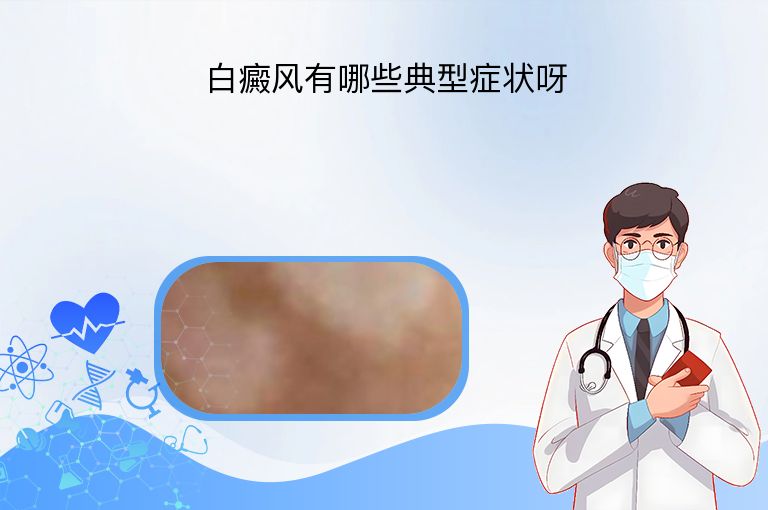 白癜风有哪些典型症状呀