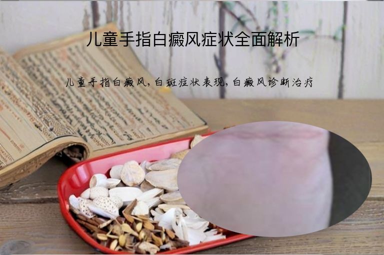 儿童手指白癜风症状全面解析”
