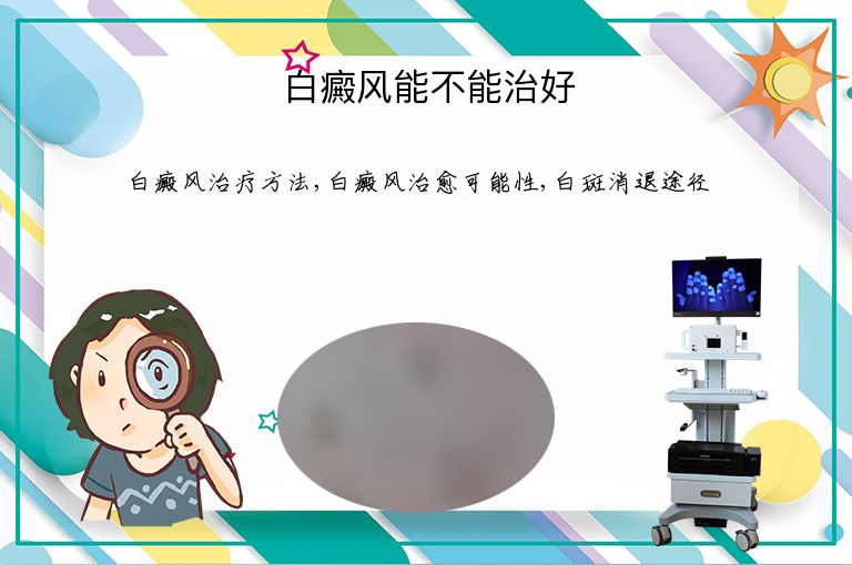 白癜风能不能治好”