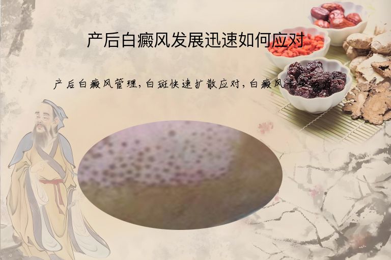 产后白癜风发展迅速如何应对”