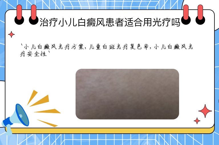 治疗小儿白癜风患者适合用光疗吗