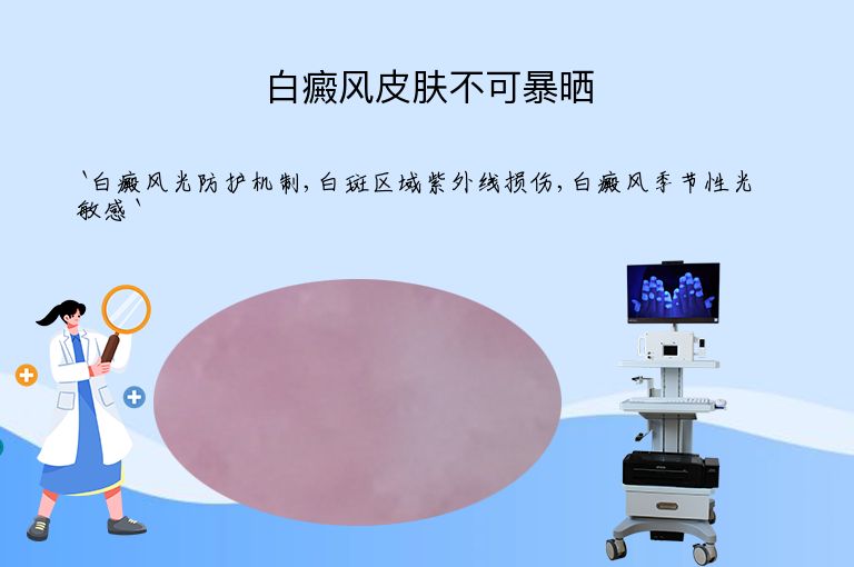 白癜风皮肤不可暴晒