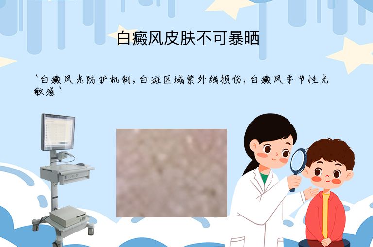 白癜风皮肤不可暴晒