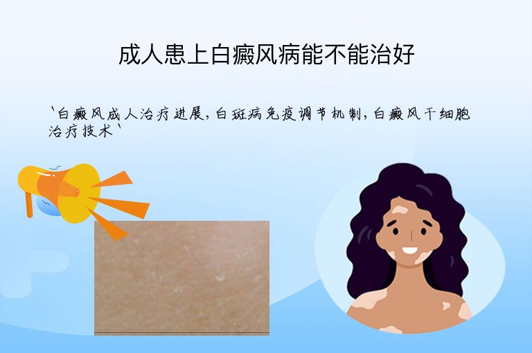 成人患上白癜风病能不能治好”