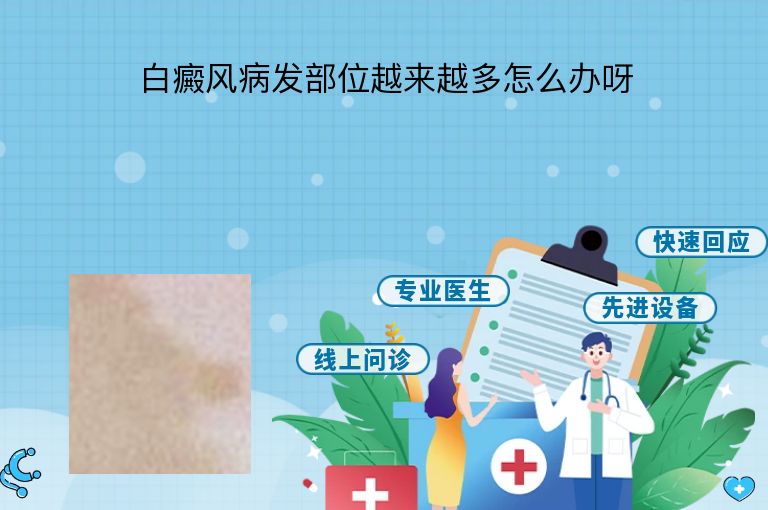 白癜风病发部位越来越多怎么办呀”