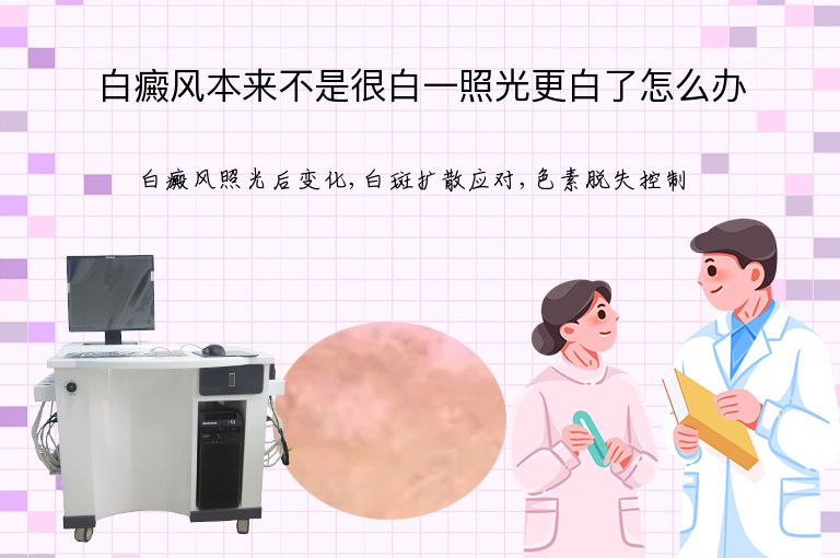 白癜风本来不是很白一照光更白了怎么办”