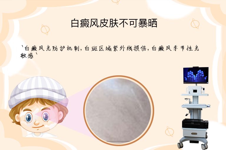白癜风皮肤不可暴晒