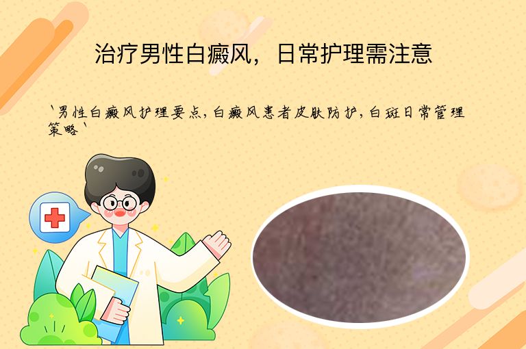 治疗男性白癜风,日常护理需注意