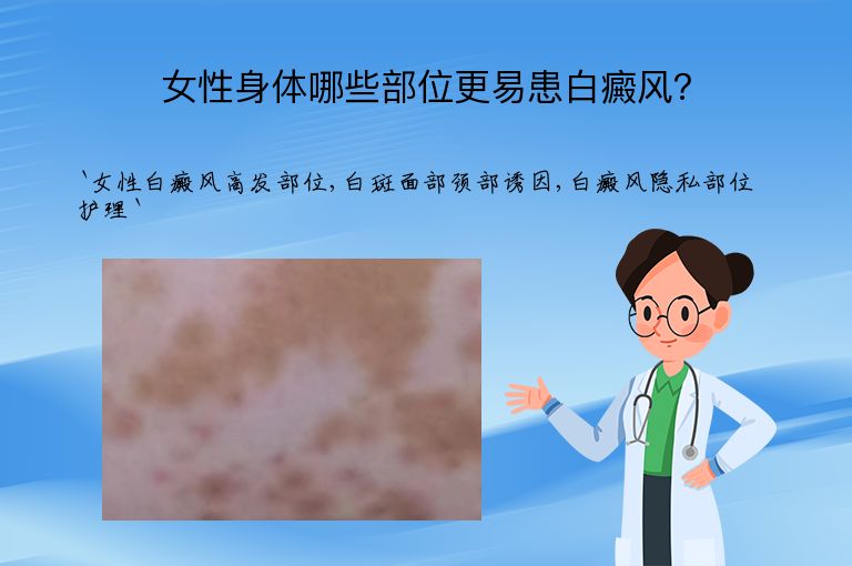 女性身体哪些部位更易患白癜风？”