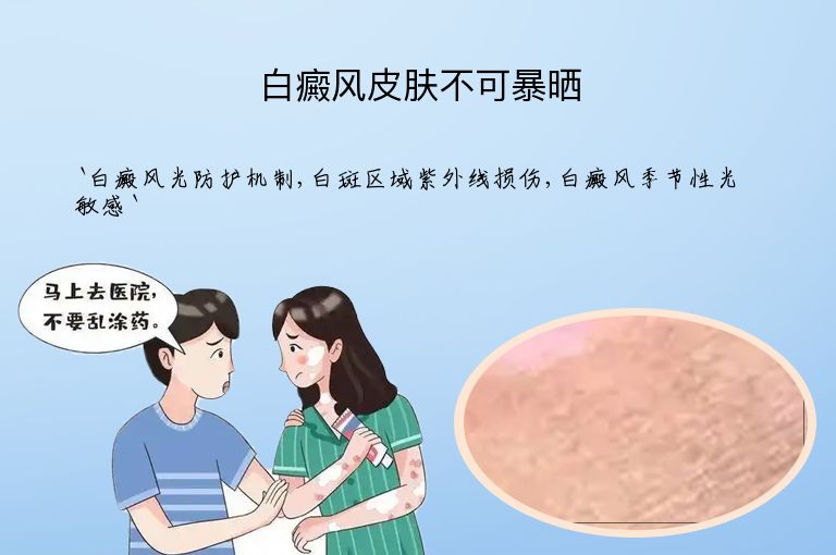 白癜风皮肤不可暴晒