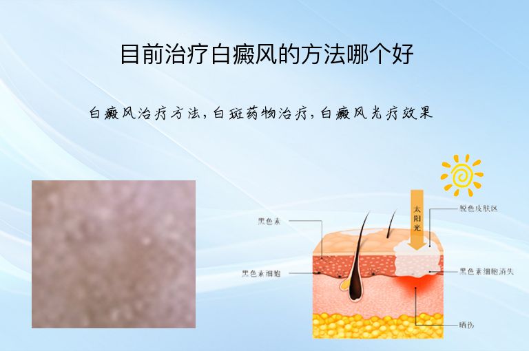 目前治疗白癜风的方法哪个好”