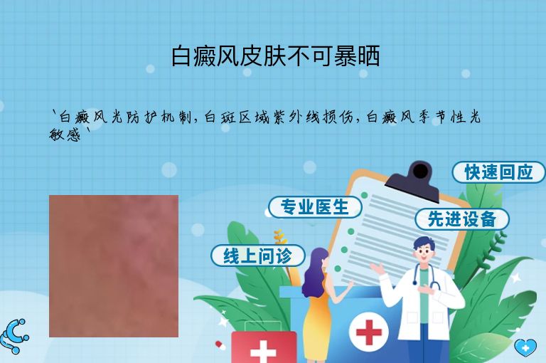 白癜风皮肤不可暴晒