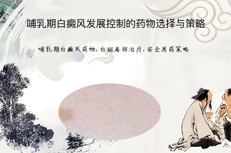 哺乳期白癜风发展控制的药物选择与策略”