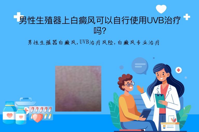 男性生殖器上白癜风可以自行使用UVB治疗吗？”