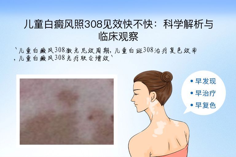 儿童白癜风照308见效快不快：科学解析与临床观察