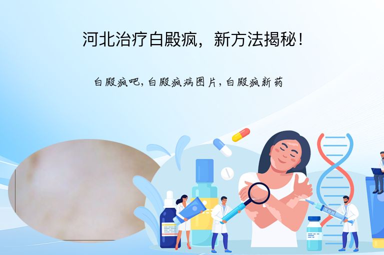河北治疗白殿疯,新方法揭秘!”