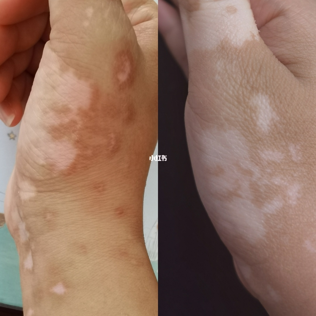 照308白斑恢复过程_为什么照308反倒白斑加重_白斑照308能阻止毛发变白吗