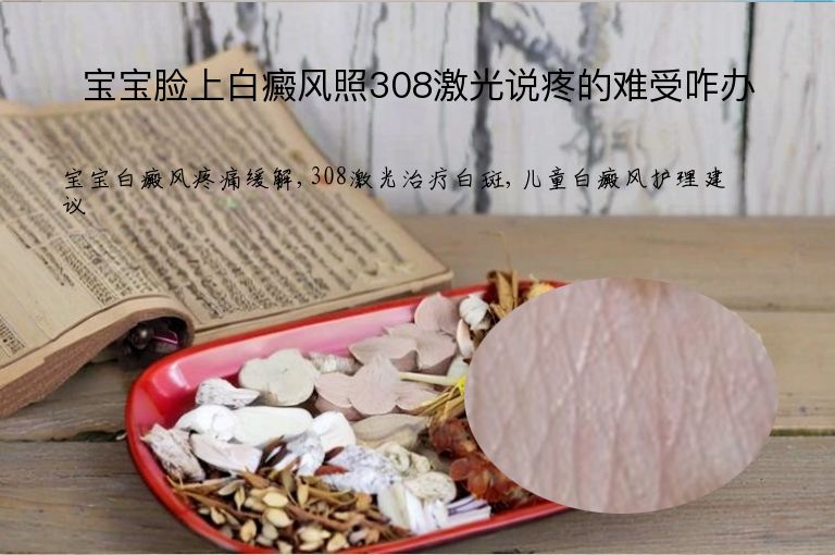 宝宝脸上白癜风照308激光说疼的难受咋办”