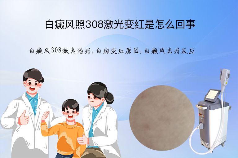 白癜风照308激光变红是怎么回事”