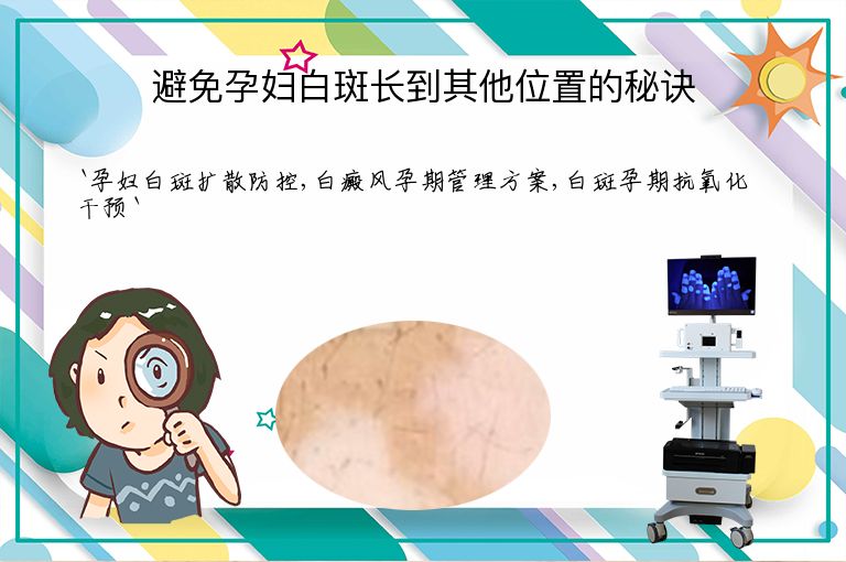 避免孕妇白斑长到其他位置的秘诀