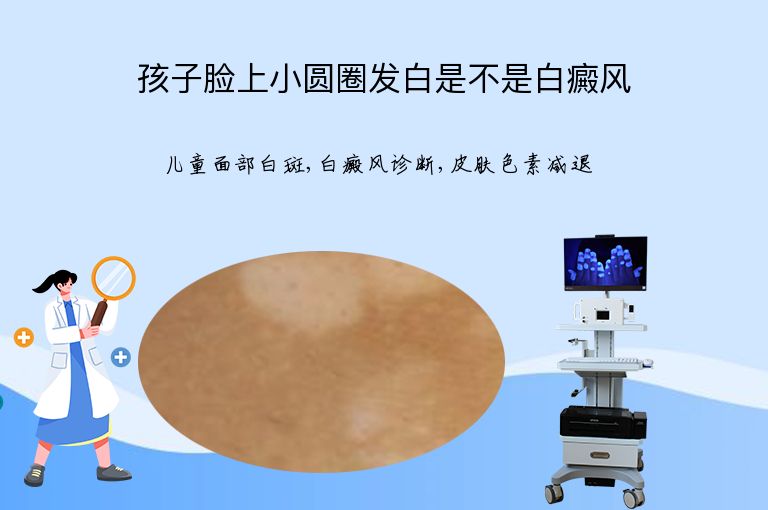 孩子脸上小圆圈发白是不是白癜风”