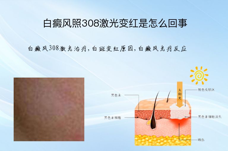 白癜风照308激光变红是怎么回事”