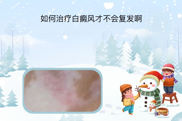如何治疗白癜风才不会复发啊”