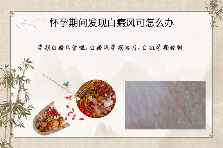 怀孕期间发现白癜风可怎么办”