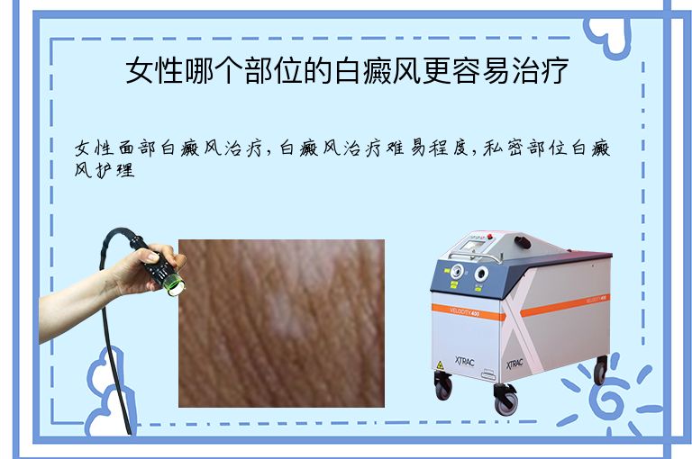 女性哪个部位的白癜风更容易治疗”