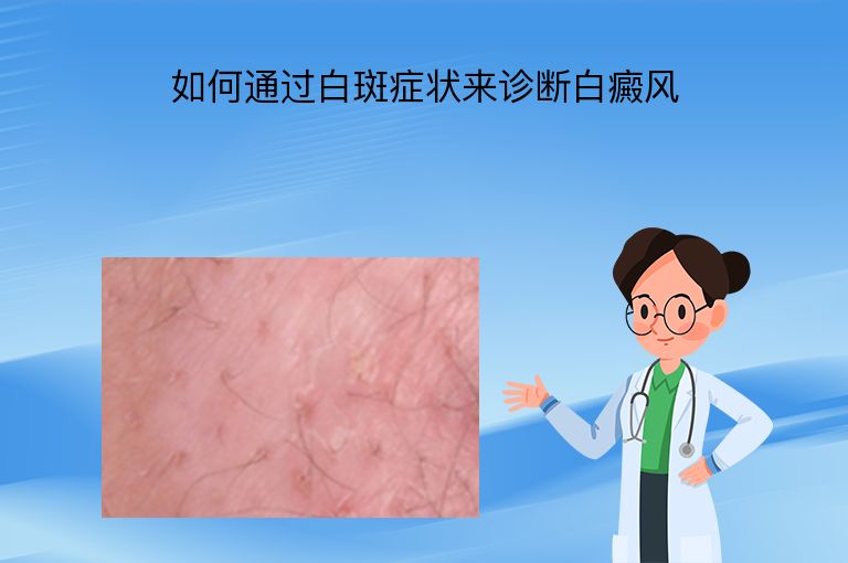 如何通过白斑症状来诊断白癜风