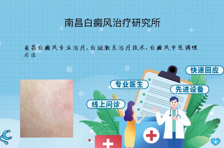 南昌白癜风治疗研究所”