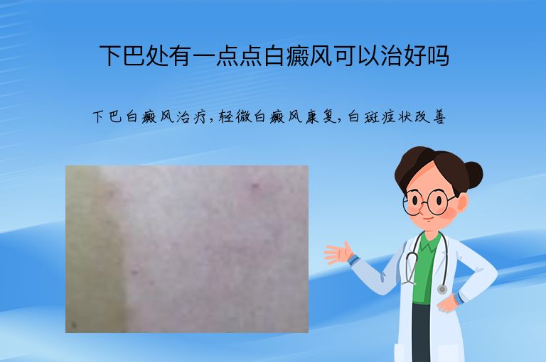下巴处有一点点白癜风可以治好吗”